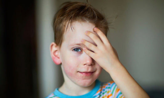 My child has Hives - Little Kids Business