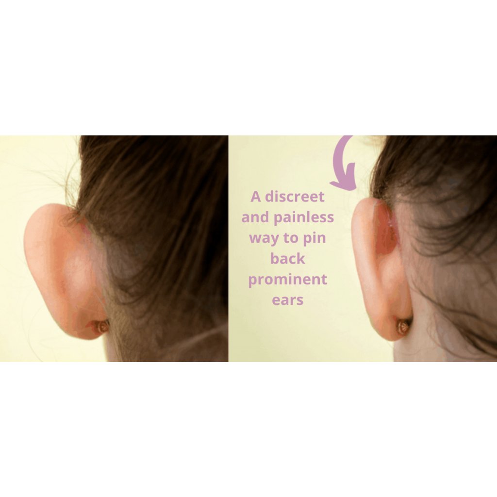 Otostick Prominent Ear Corrector for Adults - Little Kids Business