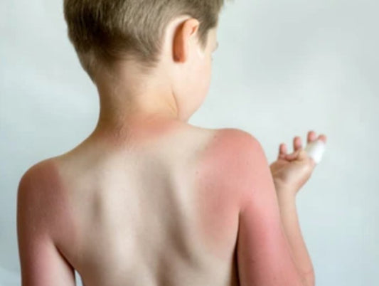 How to treat a sunburnt child - Little Kids Business 