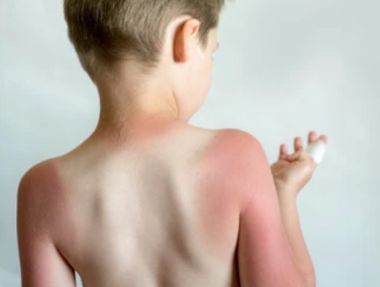 How to treat a sunburnt child - Little Kids Business