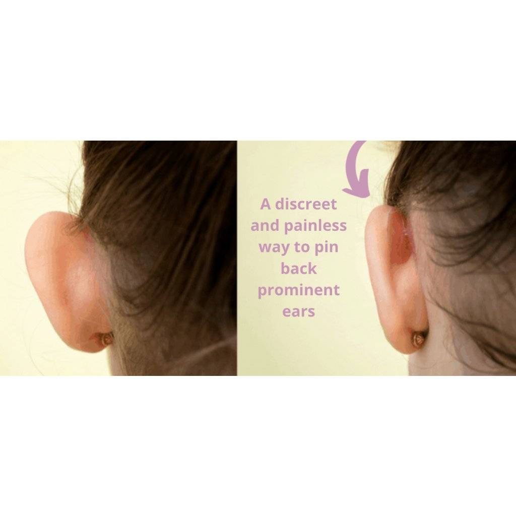 Otostick Australia Baby Infant Ear Tape Ear Correctors with Head Cap - Little Kids Business